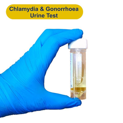 Gloved hand holding urine container