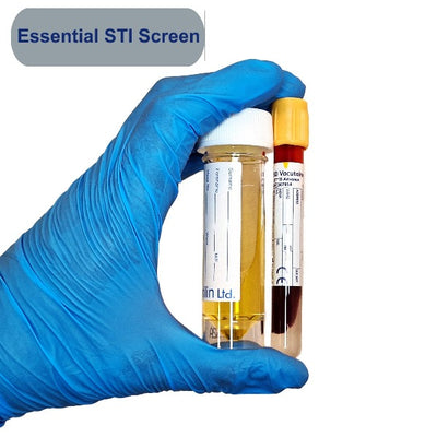 Gloved hand holding urine container and blood tube